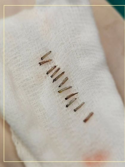 A close-up of extracted hair grafts. Notice how each one is intact and healthy. Our Perfect-i technique allows us to extract these follicles with negligible damage, which is essential for ensuring they survive and grow after transplantation.