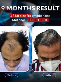 Hair Transplant Surgery