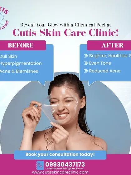 This graphic clearly shows the transformative effects of a chemical peel. I use peels to address issues like dullness, hyperpigmentation, and acne. The 'after' state shows what you can expect: brighter, healthier skin with a more even tone and reduced blemishes.