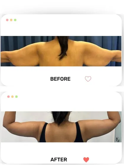 This is another view of an arm lift (brachioplasty) result. The before photo shows excess skin and fat on the back of the arms and upper back, which has been significantly reduced in the after photo for a smoother contour.