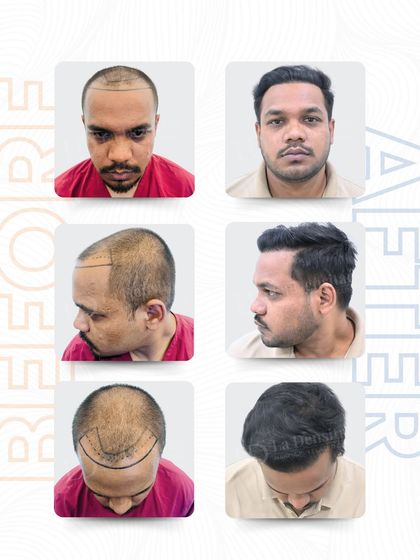 This six-panel view shows Gautham Kumar's complete hair transplant result. From the initial markings to the final look, every graft was placed with care to create a transformation that feels both effortless and real.