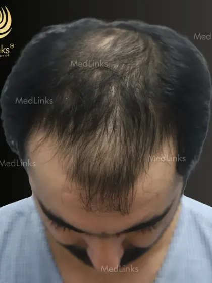 A top-down view of the same patient, clearly illustrating the pattern of baldness. This is the canvas on which we will work to create a natural and dense hair restoration result.