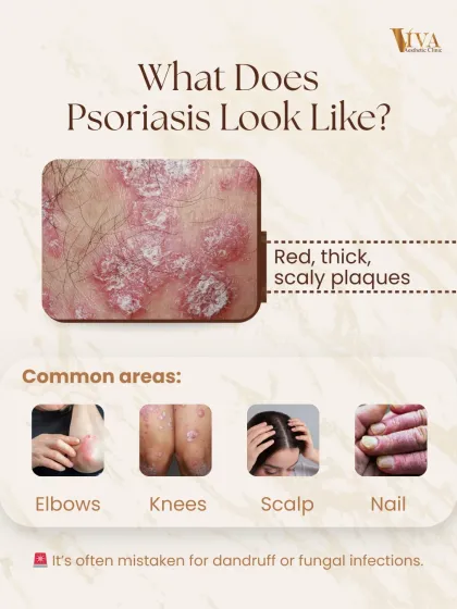 This visual guide shows what psoriasis typically looks like: red, thick, scaly plaques. It commonly appears on elbows, knees, the scalp, and even nails, and is often mistaken for dandruff or a fungal infection, making a correct diagnosis essential.