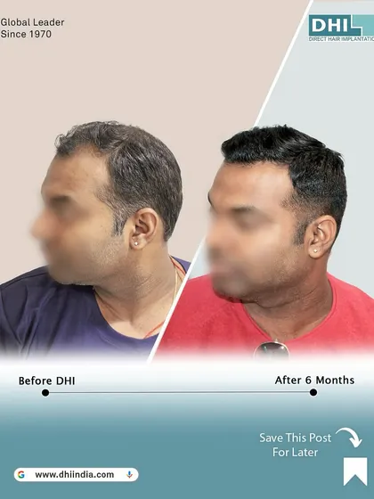 Another side-profile view of the 6-month transformation. This angle showcases the seamless integration of the new hair, creating a natural and aesthetically pleasing result.