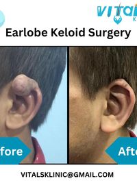 Dermatosurgery (Minor Procedures)