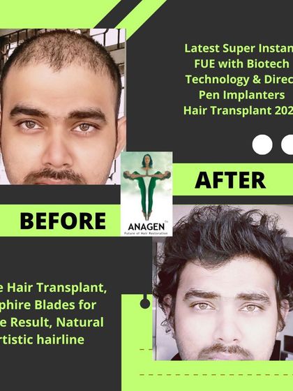 A before and after image demonstrating the dense, natural, and artistic hairline achieved with our latest Super Instant FUE with Biotech Technology.