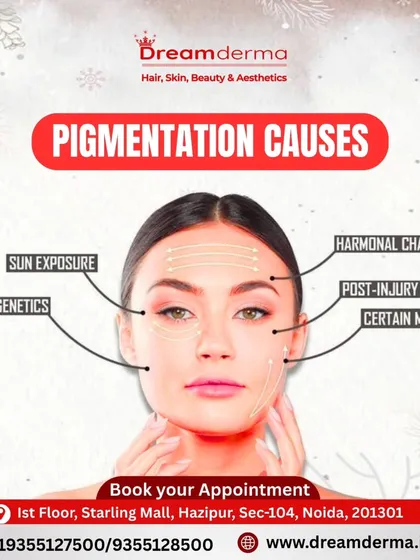 Understanding the cause of your pigmentation is the first step to treating it. This graphic illustrates common causes like sun exposure, genetics, and hormonal changes. A consultation with our dermatologists can identify the source of your concern.
