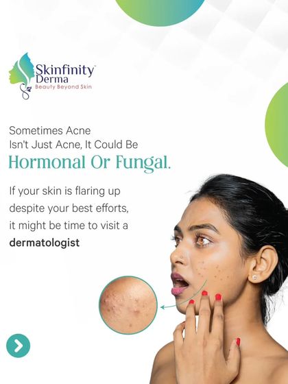 As highlighted in our Times of India feature, sometimes acne isn't just acne. It could be hormonal or fungal, which is why consulting a dermatologist for a proper diagnosis is crucial.