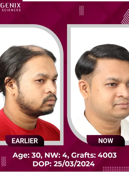 Witness the life-changing results for this 30-year-old after a 4003-graft procedure for Grade 4 baldness.