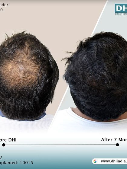 A top-down view of the same client's 7-month progress. This image clearly shows the significant improvement in coverage and density across the scalp, demonstrating the effectiveness of our DHI procedure.