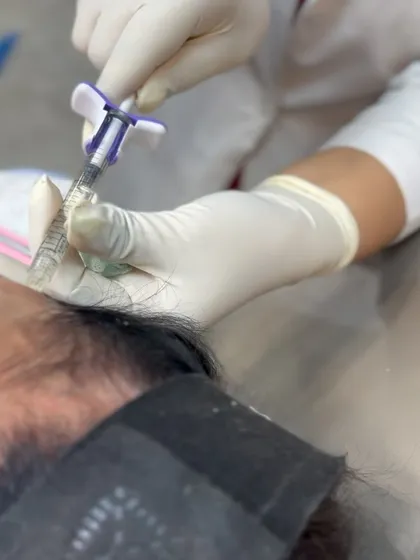 Safety and precision are paramount. This image shows the preparation of a sterile dermal filler syringe, ready for a facial contouring procedure.