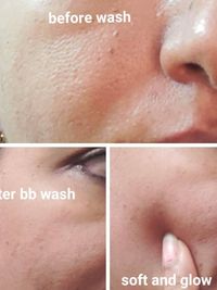Acne & Pimple Treatment