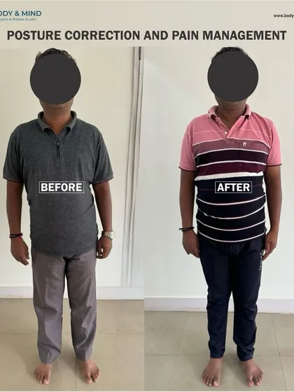 This before and after image shows a significant improvement in posture for one of my clients. By addressing the root cause of his chronic pain through targeted physiotherapy and Pilates, we were able to realign his body, reduce strain, and help him move without discomfort.
