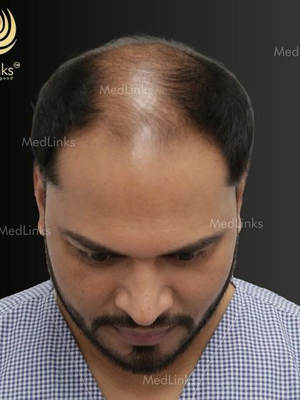 A top-down view of the patient's hair loss before the transplant.