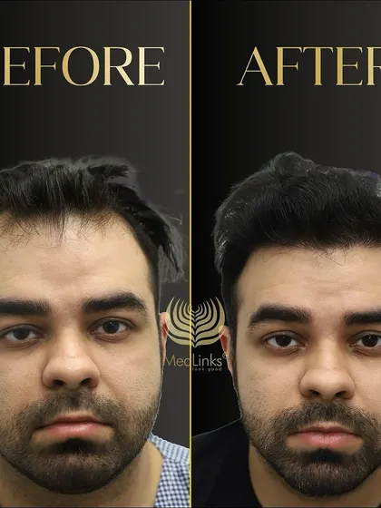 A great before and after transformation. The patient's new hair looks natural, dense, and has completely revitalized his appearance.