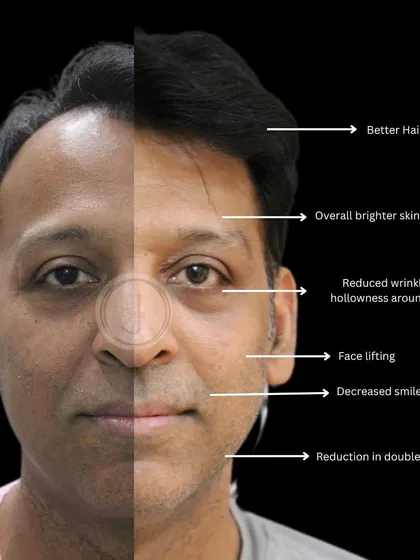 Skincare is for everyone. This patient's transformation journey focused on facial rejuvenation to combat sun damage and dehydration. We used a combination of skin tightening procedures and modulators to achieve a brighter skin tone, reduced wrinkles, and an overall lifted, more youthful appearance.