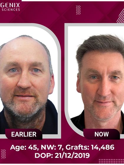 An incredible transformation of a 45-year-old international patient with Grade 7 baldness, who received 14,486 grafts for a full head of hair.