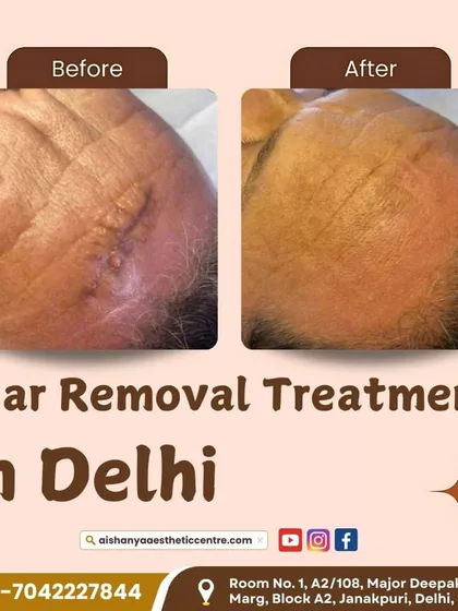 This before-and-after demonstrates a successful scar removal treatment on the forehead. The treatment significantly flattened and faded the scar, blending it with the surrounding skin for a much less noticeable appearance.