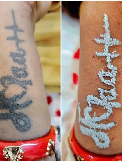 Here is a direct comparison showing a client's forearm tattoo before treatment and immediately after one session. The white frosting indicates the laser has successfully shattered the ink particles beneath the skin, starting the natural fading process.