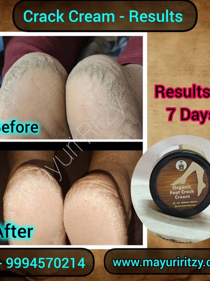 I always say my Organic Foot Crack Cream works in days, and here is the proof. This customer saw these results in just 7 days. The deep cracks have healed, and the skin is much smoother.