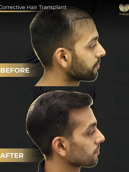 A bad hair transplant can be devastating. This is a corrective procedure we performed to fix a previous, poorly done transplant from another clinic. Using 3500 grafts with our Perfect-i technique, we were able to create the natural, dense result the patient originally wanted.
