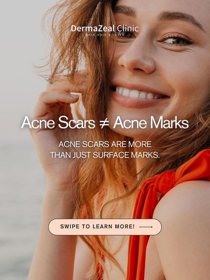 It's important to understand that acne scars are not the same as acne marks. Scars are deeper and require more advanced treatments to see significant improvement.