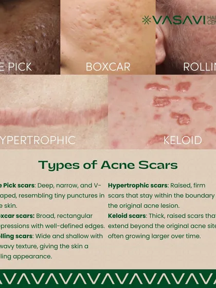 This guide illustrates the primary types of acne scars I treat. It is important to distinguish between atrophic scars like ice pick, boxcar, and rolling types, which are depressions in the skin, and hypertrophic or keloid scars, which are raised. Each requires a different therapeutic strategy for optimal results.