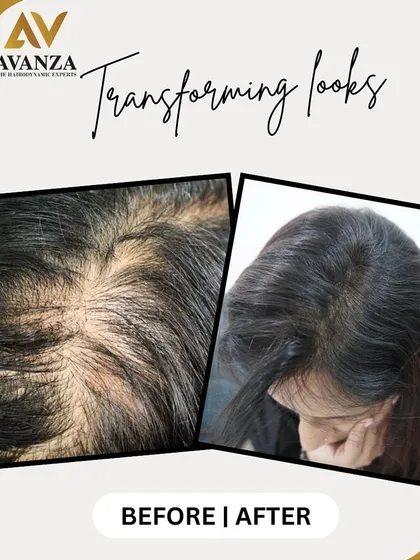 This is what we mean by "transforming looks." This before and after image shows the significant increase in hair density and scalp coverage for one of our clients. We focus on creating natural-looking results that make a real difference.