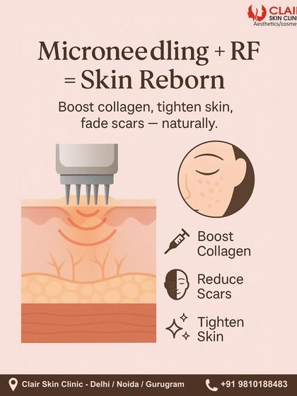 Microneedling + RF = Skin Reborn. This graphic illustrates how MNRF works by creating micro-injuries to trigger a healing response while RF energy tightens tissue. This dual action effectively boosts collagen, reduces scars, and tightens skin.