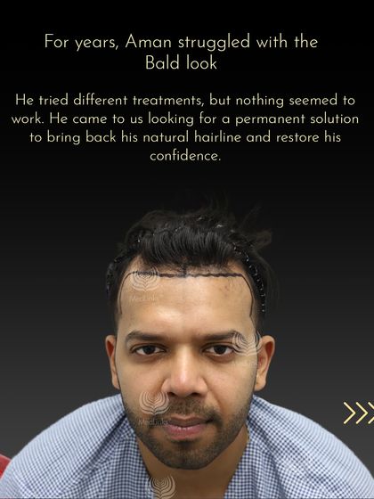 For years, Aman struggled with a bald look and had lost hope after trying different treatments. He came to us seeking a permanent solution, and this photo shows the first step: mapping out a new hairline to restore his confidence.
