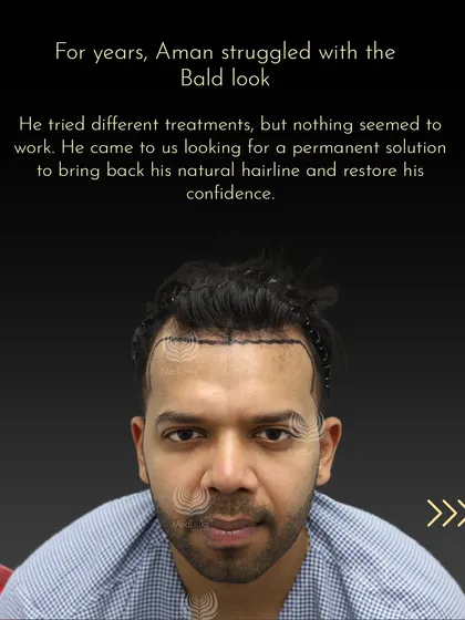 For years, Aman struggled with a bald look and had lost hope after trying different treatments. He came to us seeking a permanent solution, and this photo shows the first step: mapping out a new hairline to restore his confidence.