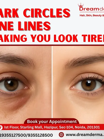 Tired-looking eyes can be refreshed. This before and after comparison demonstrates our expertise in treating dark circles and fine lines. Our targeted approach restores brightness and youthfulness to the delicate under-eye area, helping you look as rested and vibrant as you feel.