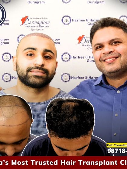 A fantastic 10-month result for this patient who received 3850 grafts. The images show his hair before the procedure, and the dense, natural growth he has now.
