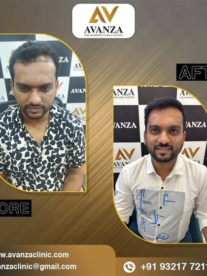 This before and after shows not just restored hair, but a restored smile. The client is visibly happier and more confident with his new look.