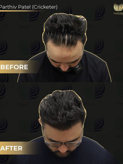 A top-down view of Parthiv Patel's transformation. This angle clearly shows how we filled in the thinning areas to create a dense and natural-looking result.