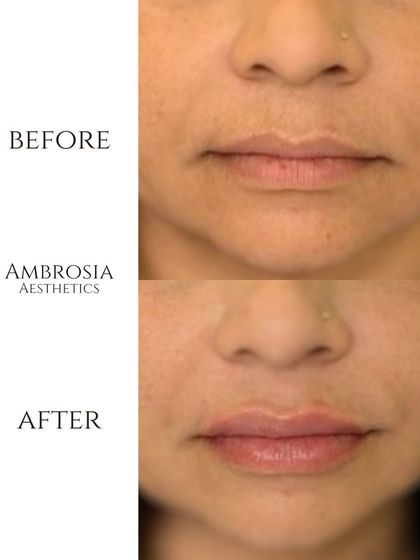 Here is another example of my approach to lip fillers. The goal was to create a fuller, more hydrated pout that remains proportionate and enhances the patient's smile naturally.