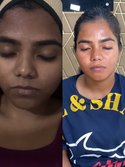 A powerful before and after from my Korean Whitening Treatment. This client came to me with significant tanning and uneven skin tone on her forehead. The after photo shows a dramatically brighter, more even complexion and that signature glass skin glow.