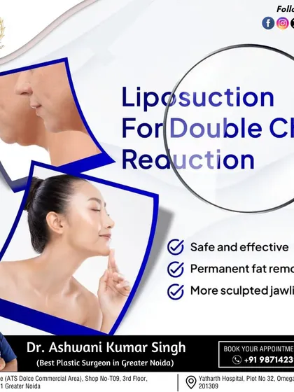 A double chin can be a persistent concern for many. I use targeted liposuction to permanently remove excess fat from under the chin, creating a more sculpted and defined jawline for a sharper facial profile.