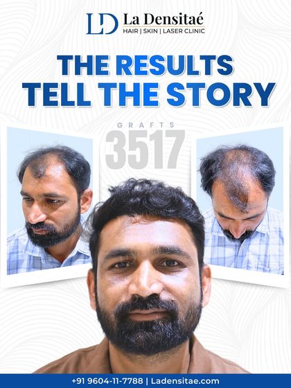 This transformation is the result of precision and patience. With 3,517 grafts implanted using my RT-FUE technique, the goal was to make it look like nothing was ever done, just a return to a natural, fuller head of hair.