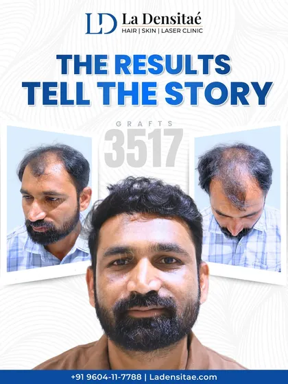 This transformation is the result of precision and patience. With 3,517 grafts implanted using my RT-FUE technique, the goal was to make it look like nothing was ever done, just a return to a natural, fuller head of hair.