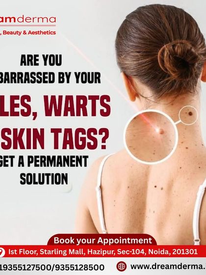 Are you embarrassed by moles, warts, or skin tags? We offer a permanent, safe, and precise solution with minimal discomfort and quick recovery, helping you achieve smooth, blemish-free skin.
