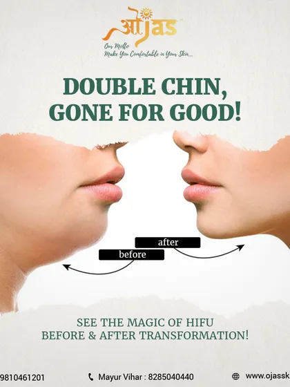 A double chin can be a stubborn concern, but surgery isn't the only option. This is a real before and after transformation using our non-surgical HIFU (High-Intensity Focused Ultrasound) treatment, which tightens and lifts the skin for a more defined jawline.