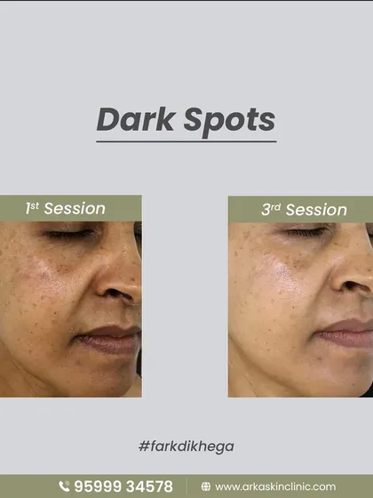 This is what I mean when I say "fark dikhega" (the difference will be visible). This before and after shows the significant reduction of dark spots and pigmentation after just three sessions. We achieved this by targeting the root cause of hyperpigmentation for clear, lasting results.