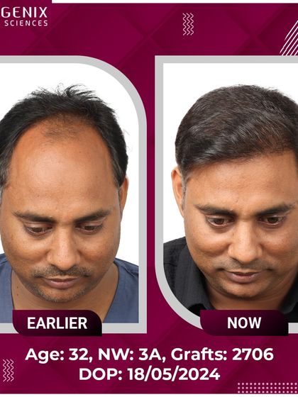 A 32-year-old patient's journey from Grade 3A baldness to a full, confident look after 2706 grafts.