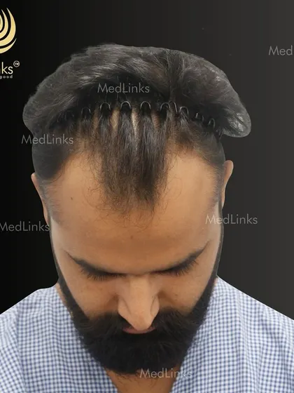 This patient is in the process of his hair transformation. The hair is sectioned to prepare for the procedure, marking the beginning of his journey back to a full head of hair.