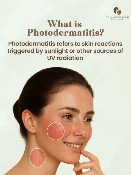 Photodermatitis is an abnormal skin reaction triggered by exposure to ultraviolet (UV) radiation from sunlight or other sources. It can present as an inflammatory rash on sun-exposed areas of the skin.