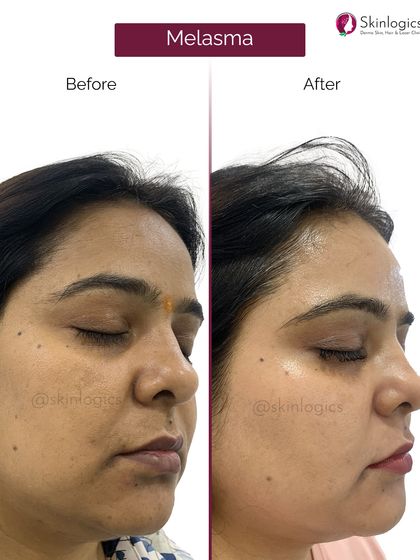 This image captures the melasma treatment progress from a different angle, confirming the consistent and effective reduction of pigmentation across the patient's face.