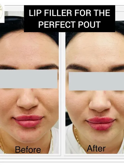 A subtle lip enhancement can beautifully balance the entire face. Here, I used dermal fillers to add natural-looking volume and definition, creating a fuller, more youthful pout while maintaining the patient's unique lip shape.