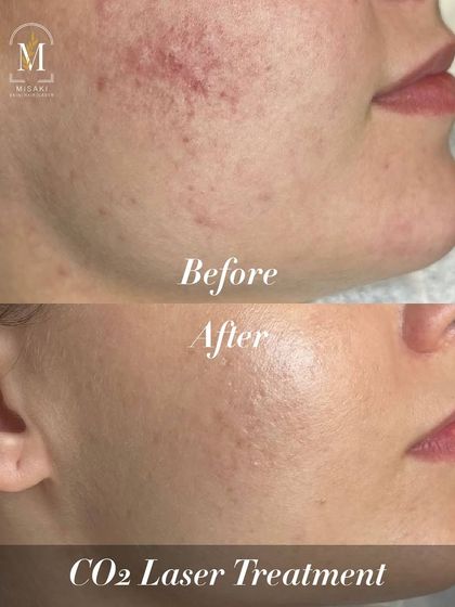 A dramatic before and after of CO2 Laser Treatment, showing a remarkable improvement in skin texture and reduction of acne-related redness and scarring.