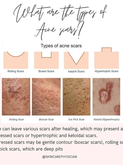 This visual guide shows the different types of acne scars, including rolling, boxcar, icepick, and hypertrophic (keloid) scars. Each type requires a different treatment approach.